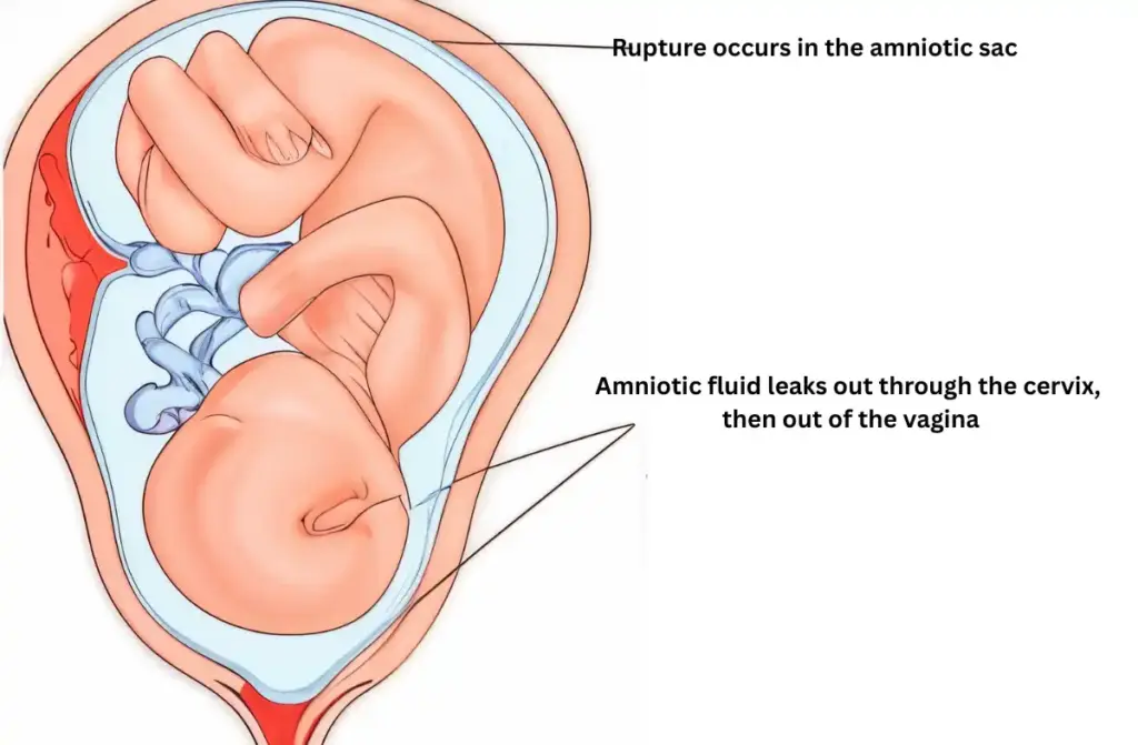 Reasons for Premature Labour
