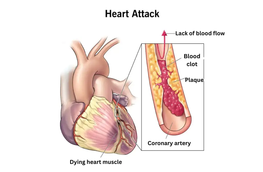 Warning Signs of a Heart Attack